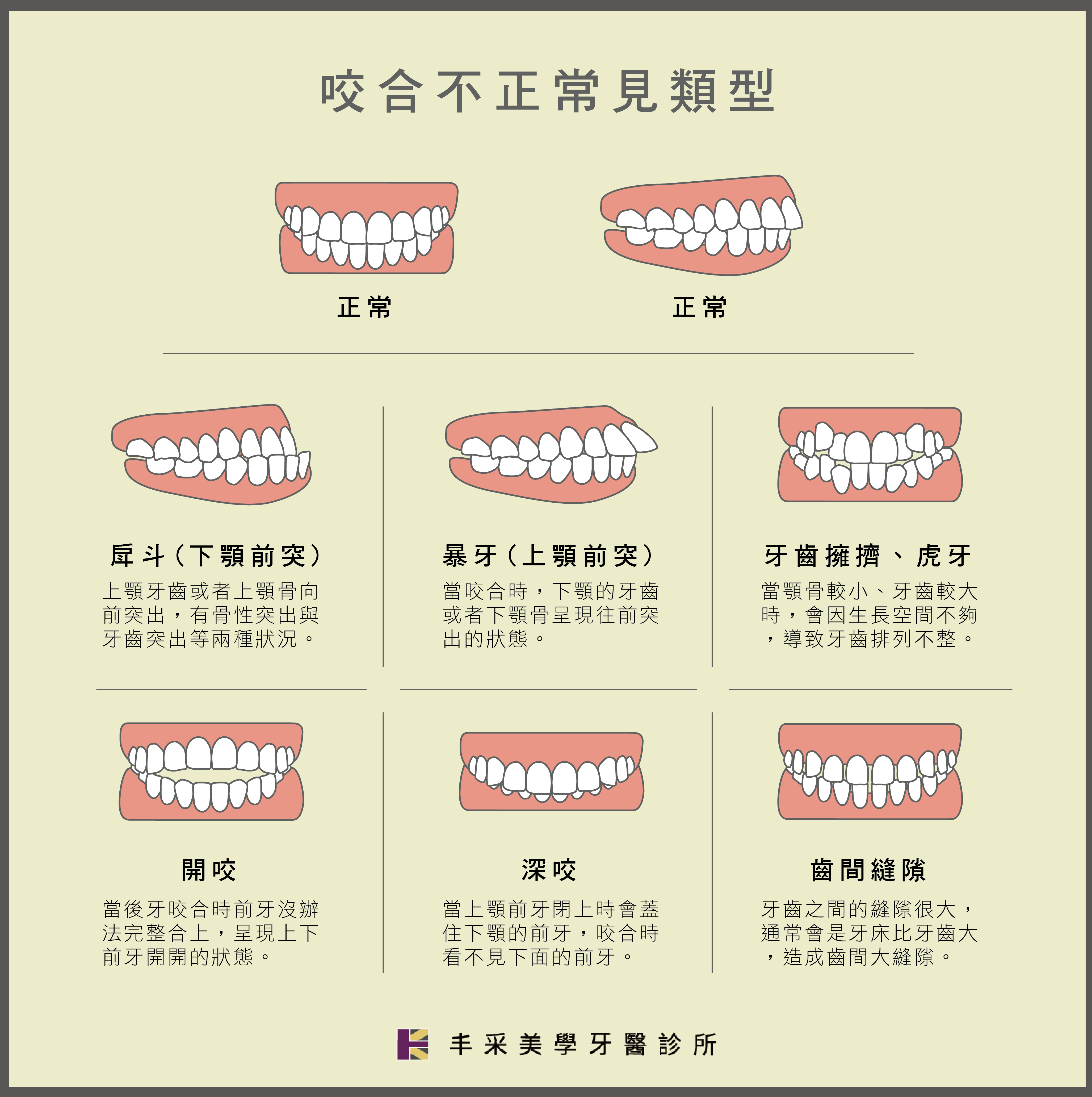 丰采美學牙醫-咬合不正常見種類 暴牙戽斗牙齒擁擠縫隙