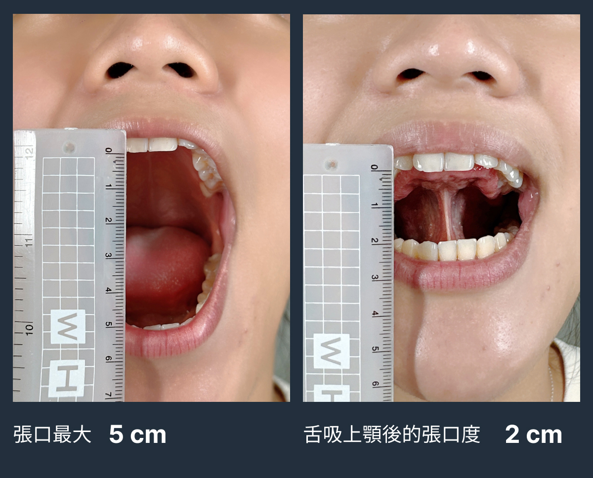 舌頭繫帶功能檢測