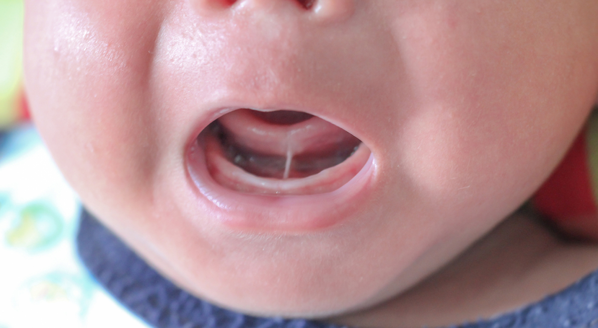 解開舌繫帶-嬰兒時期