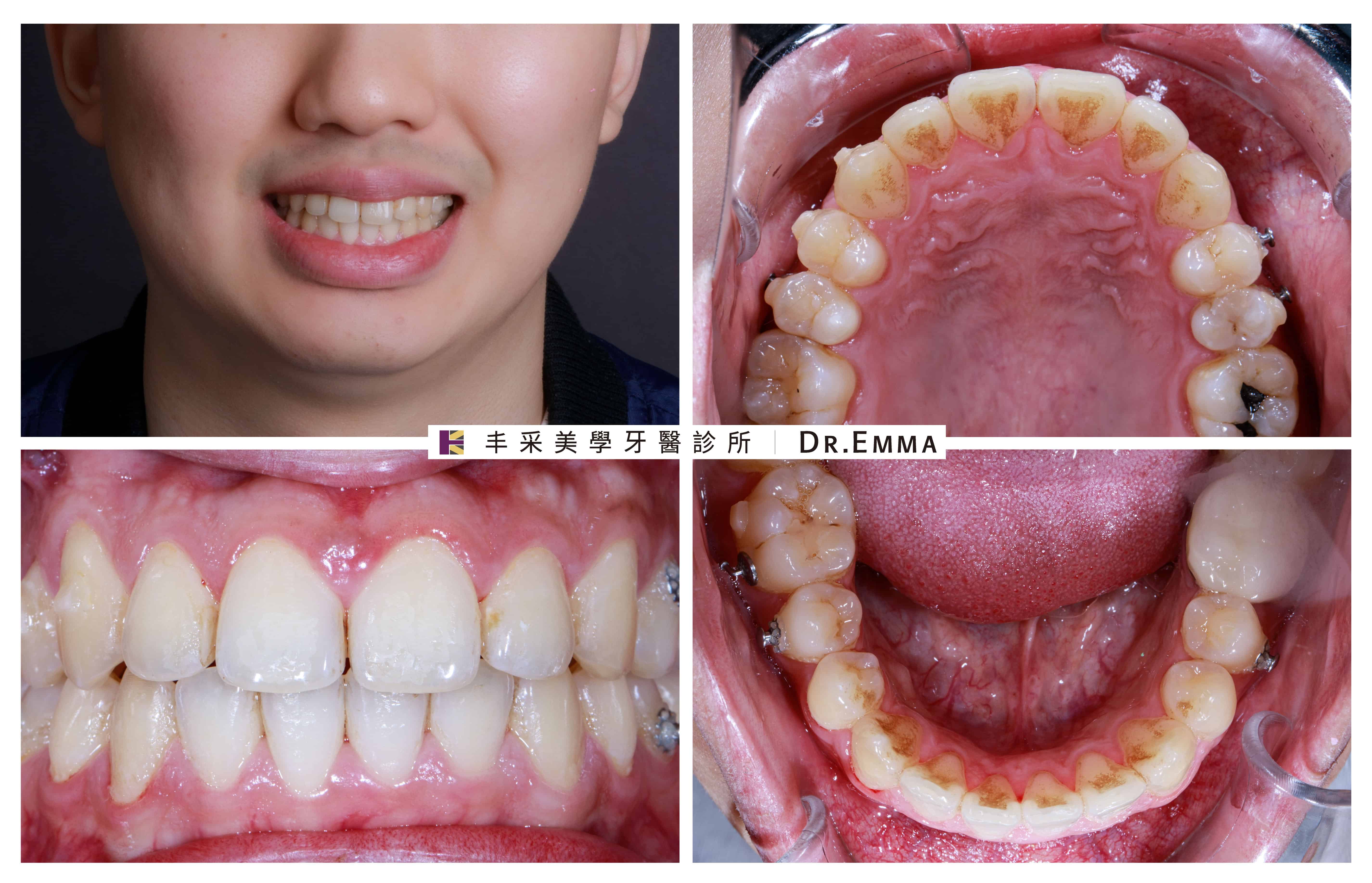 二次牙齒矯正-劉先生案例-2