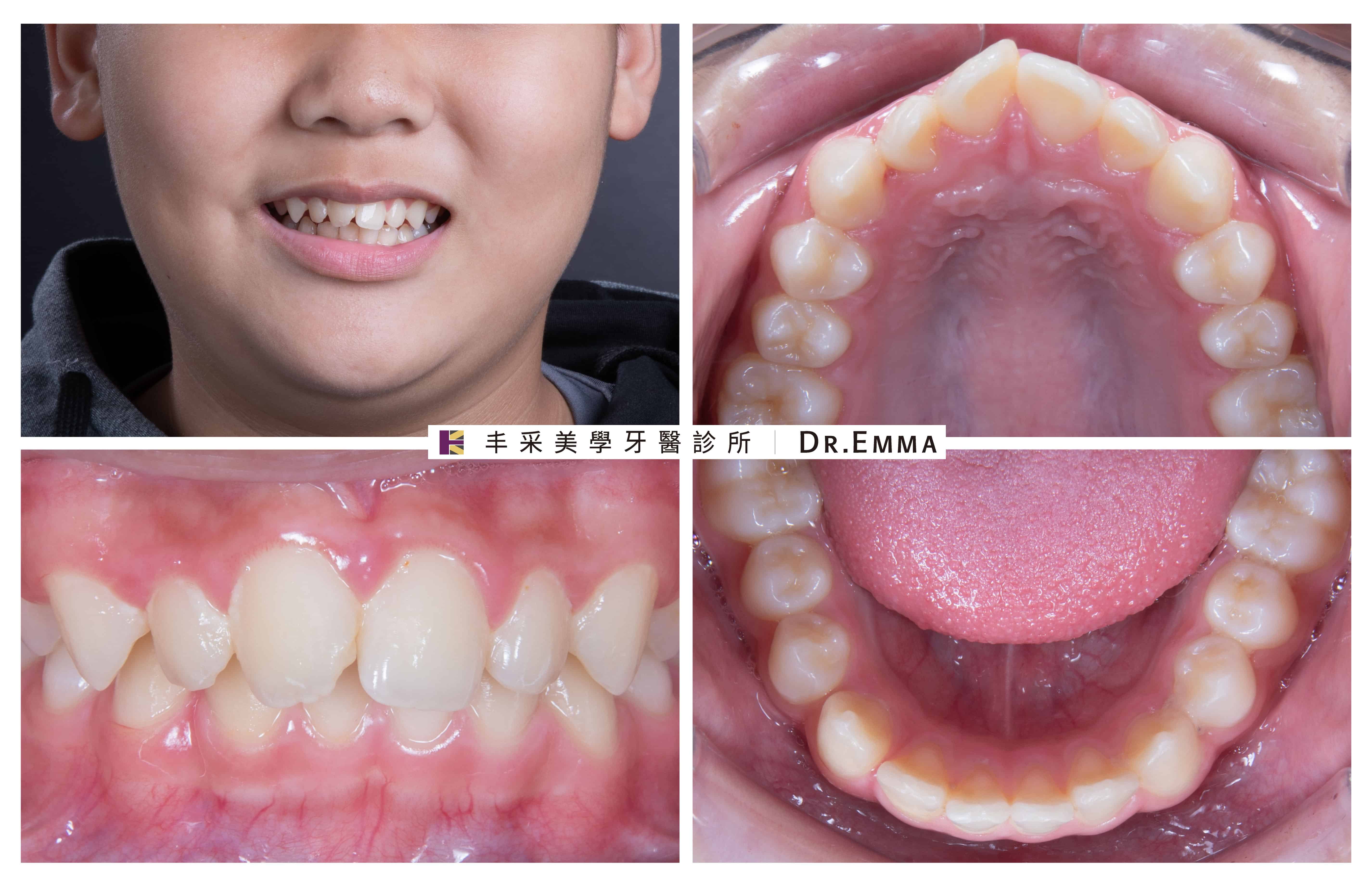 牙齒矯正案例-王同學-1